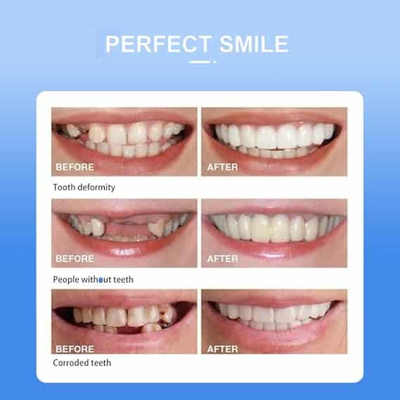 Snap-On Smile Veneers: Revolutionizing Your Smile